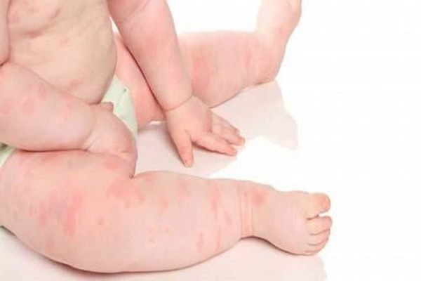 Nổi mề đay ở trẻ em: Nguyên nhân, biểu hiện và cách chữa tốt nhất cho bé