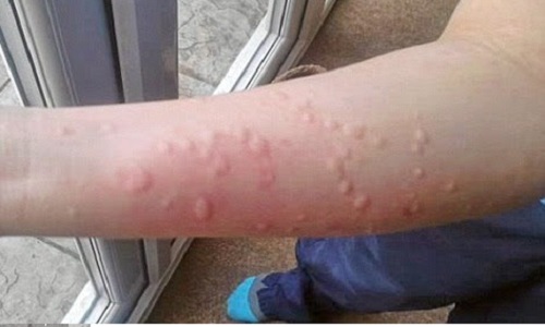 Mề đay cấp tính: Nguyên nhân và cách chữa trị mau khỏi nhất