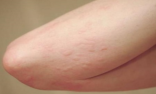 Mề đay cấp tính: Nguyên nhân và cách chữa trị mau khỏi nhất