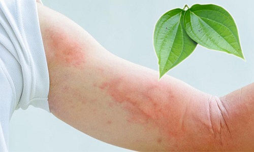 10 cách trị nổi mề đay tại nhà rất hiệu nghiệm từ chuyên gia da liễu