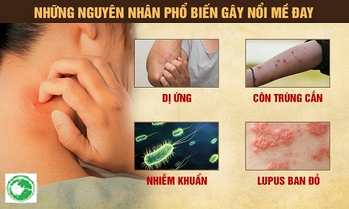 Mề đay mãn tính: Nguyên nhân và cách chữa bằng Đông y hiệu quả