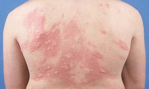Mề đay mãn tính: Nguyên nhân và cách chữa bằng Đông y hiệu quả