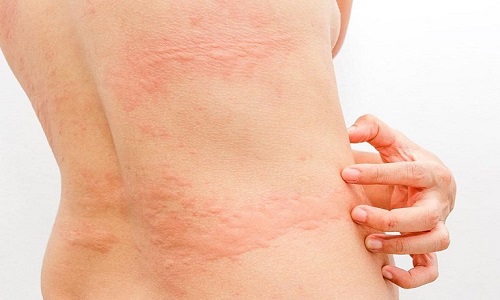 Bị nổi mề đay kiêng gì để không nặng thêm, bệnh nhanh khỏi