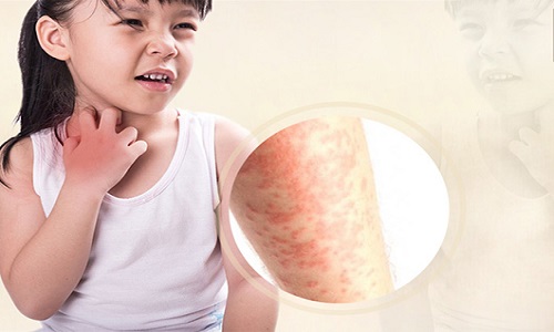 Bị nổi mề đay ở cổ: Nguyên nhân và cách xử lý hiệu quả từ chuyên gia