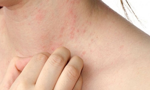 Bị nổi mề đay ở cổ: Nguyên nhân và cách xử lý hiệu quả từ chuyên gia