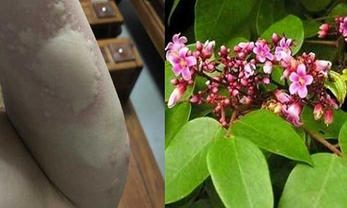 Cách chữa nổi mề đay dân gian được các bác sĩ khuyên dùng
