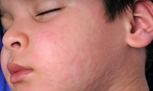 Nổi mề đay ở mặt: Nguyên nhân và cách trị bệnh hữu hiệu nhất