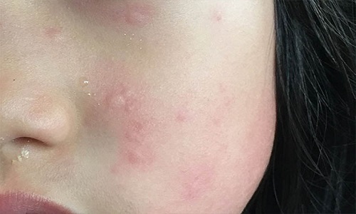 Nổi mề đay ở mặt: Nguyên nhân và cách trị bệnh hữu hiệu nhất