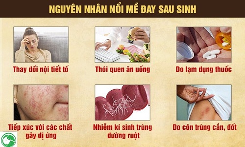 Bị nổi mề đay sau sinh bao lâu thì hết? Nguyên nhân và cách chữa