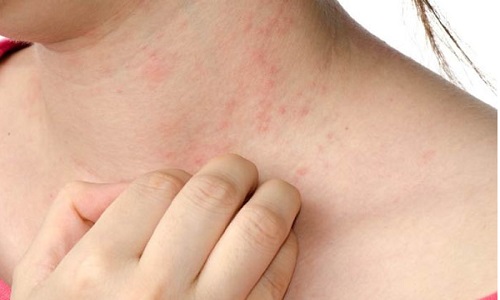Bị nổi mề đay sau sinh bao lâu thì hết? Nguyên nhân và cách chữa