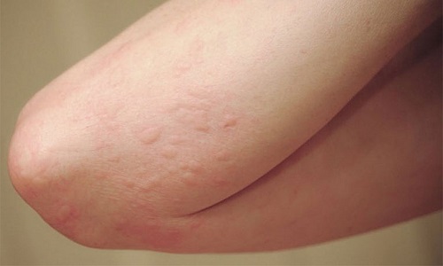 Bị nổi mề đay kiêng gì để không nặng thêm, bệnh nhanh khỏi