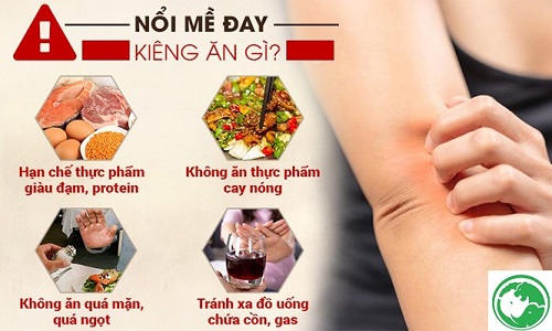 Bị nổi mề đay kiêng gì để không nặng thêm, bệnh nhanh khỏi