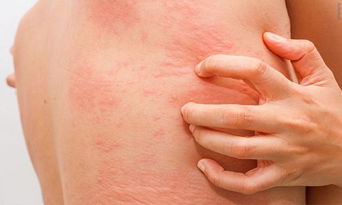 Nổi mề đay có tự khỏi không, bao lâu thì hết và cách xử lý