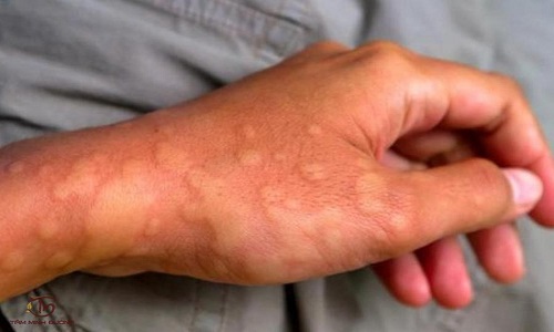 Nổi mề đay có tự khỏi không, bao lâu thì hết và cách xử lý