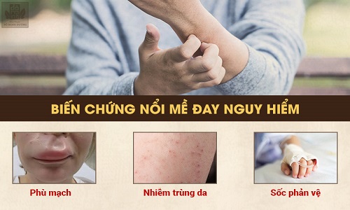 Nổi mề đay có tự khỏi không, bao lâu thì hết và cách xử lý