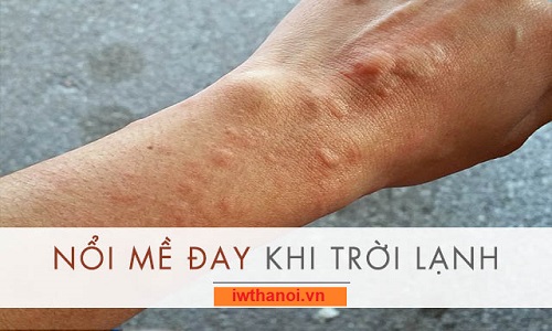 Bị nổi mề đay khi trời lạnh phải làm sao, xử lý thế nào cho nhanh khỏi ?