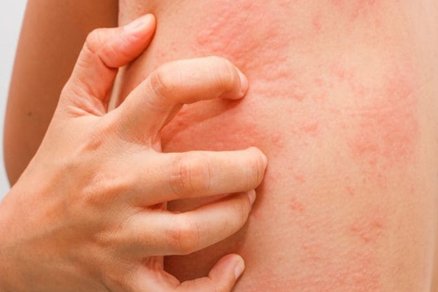 Nổi mề đay là gì? Nguyên nhân, dấu hiệu và cách chữa không tái phát
