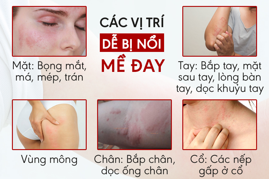 Nổi mề đay là gì? Nguyên nhân, dấu hiệu và cách chữa không tái phát