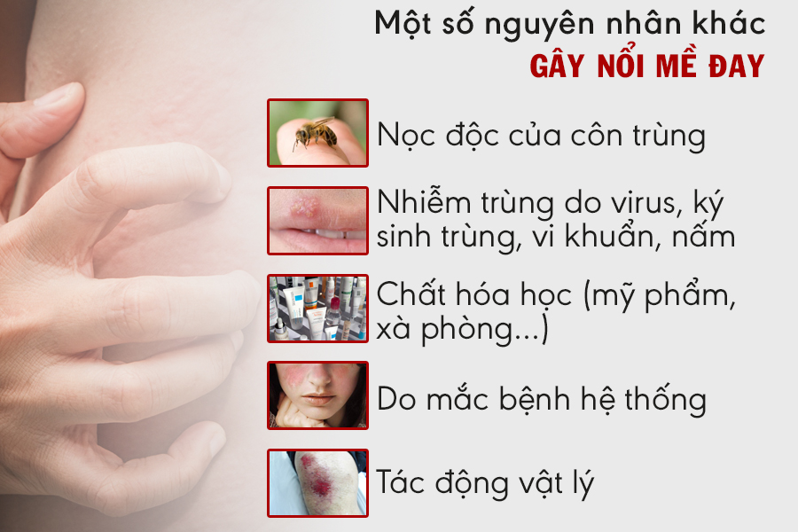 Nổi mề đay là gì? Nguyên nhân, dấu hiệu và cách chữa không tái phát