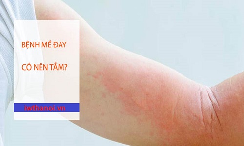 Bị nổi mề đay có được tắm không và tắm lá gì tốt nhất?