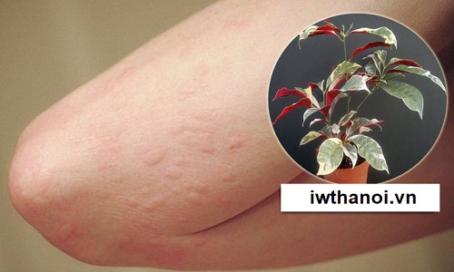 Lá đơn đỏ chữa mề đay: Bài thuốc an toàn, hiệu quả và tiết kiệm