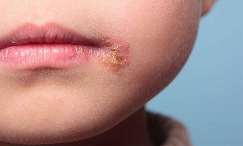 Cách trị mụn ở môi nhanh nhất và hiệu quả nhất bằng thiên nhiên