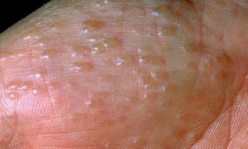 Cách trị mụn nước ở tay, ở chân, ở môi, ở mặt tại nhà