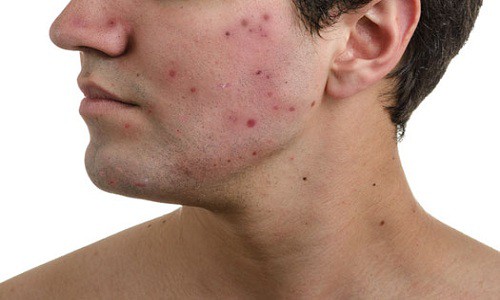 Cách trị mụn cho nam giới da dầu ở tuổi dậy thì tại nhà