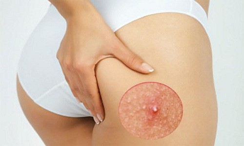 Cách trị mụn ở mông tại nhà nhanh nhất không để lại sẹo