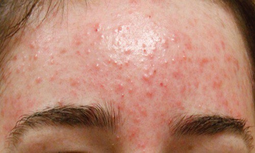 Cách trị mụn ở trán, má và cằm tại nhà nhanh, hiệu quả nhất