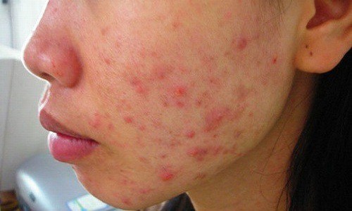 Cách trị mụn mủ sưng to và đỏ ở mặt, ở mũi tại nhà