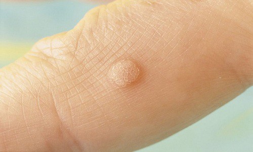 Cách trị mụn cơm ở tay, ở chân, ở mặt quanh mắt tại nhà
