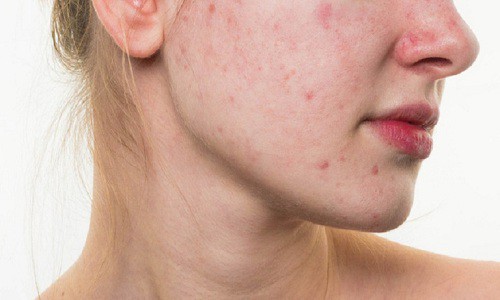 Cách trị mụn viêm đỏ không nhân, sưng dưới da tại nhà hiệu quả