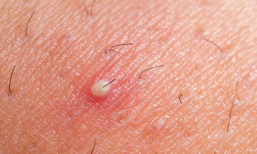 Cách trị mụn nhọt sưng to ở mông, mặt tại nhà tận gốc nhanh nhất