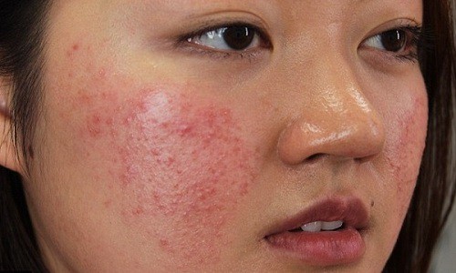 Cách trị mụn thâm đỏ ở mặt tự nhiên tại nhà hiệu quả nhanh nhất