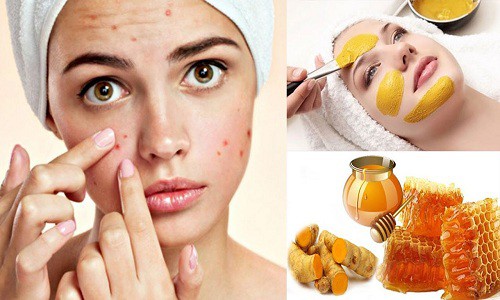 Cách trị mụn thâm đỏ ở mặt tự nhiên tại nhà hiệu quả nhanh nhất
