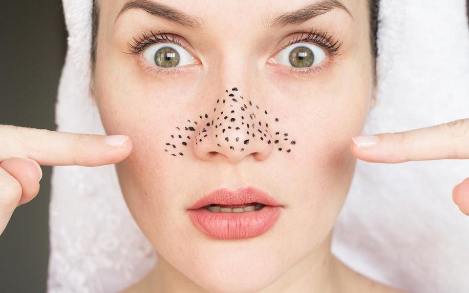 Cách trị mụn đầu đen ở mũi tại nhà hiệu quả tận gốc