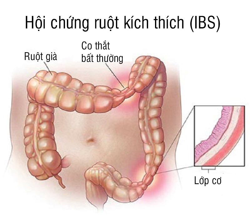Hội chứng ruột kích thích gây đau thắt lưng