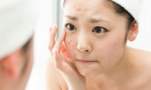 Cách trị mụn trứng cá tuổi dậy thì ở nữ, nam đơn giản tại nhà