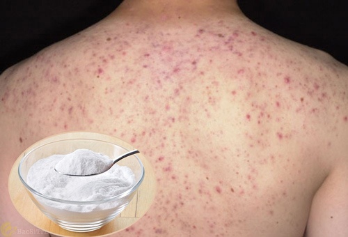 baking soda trị mụn đầu đen