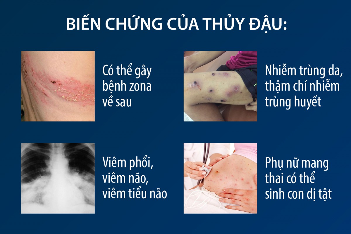 Bệnh thủy đậu ở người lớn là gì? Dấu hiệu và cách chữa trị
