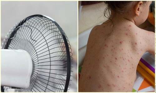 Bệnh thủy đậu kiêng gì, kiêng ăn gì, kiêng gió quạt và được gội đầu không?