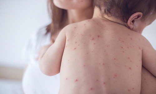 Bệnh thủy đậu ở trẻ em, trẻ sơ sinh phải làm sao và cách chữa