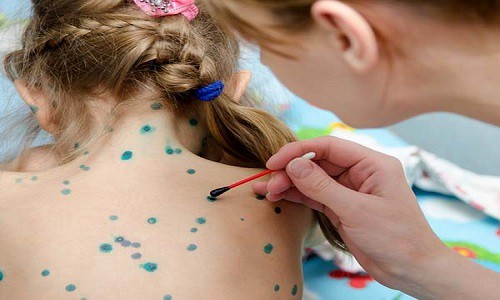 Bệnh thủy đậu có được tắm không, tắm lá nước gì nhanh khỏi?