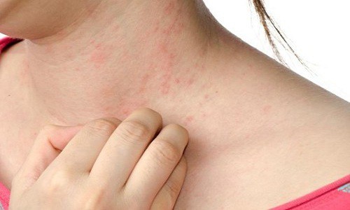 Bệnh thủy đậu bao lâu thì khỏi, bao lâu thì xẹp vỡ và hết ngứa?