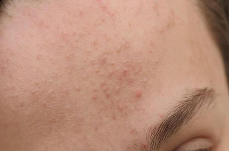 Cách trị mụn ẩn tại nhà bằng thiên nhiên đơn giản !