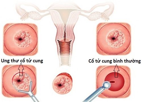 Hình ảnh cổ tử cung bình thường