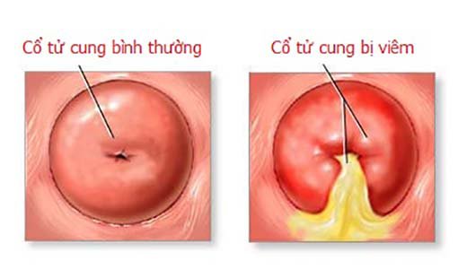 Hình ảnh bệnh phụ khoa nữ