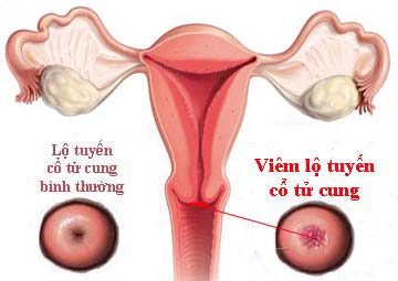 Hình ảnh bệnh phụ khoa nữ