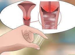 Chảy máu vùng kín khi đi vệ sinh do viêm nhiễm phụ khoa